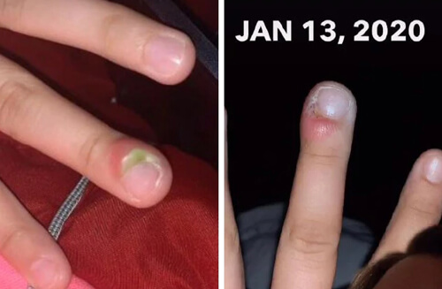 Привычка грызть ногти оказалась куда вреднее, чем думала девушка