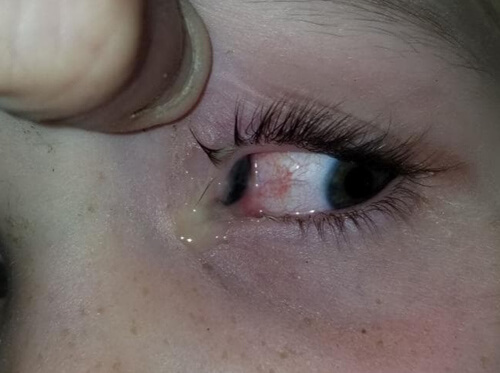 Из глаза маленькой пациентки, приехавшей в больницу, выпал жук